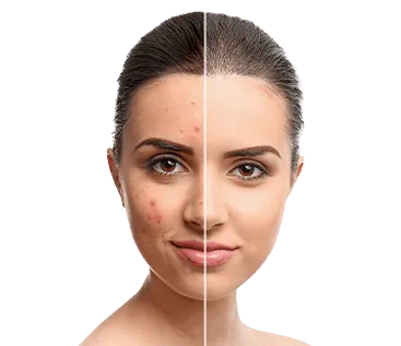 Home pimple treatment